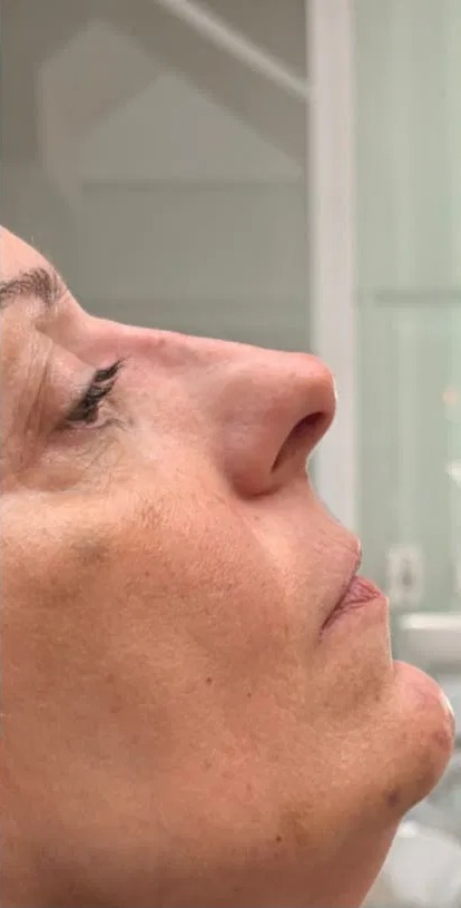 Resultado depois — Harmonização Orofacial