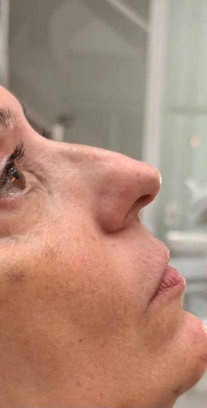 Resultado antes — Harmonização Orofacial
