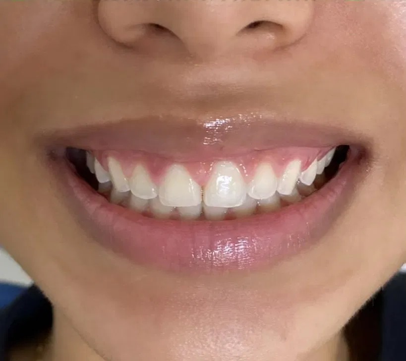 Resultado depois — Facetas em Resina