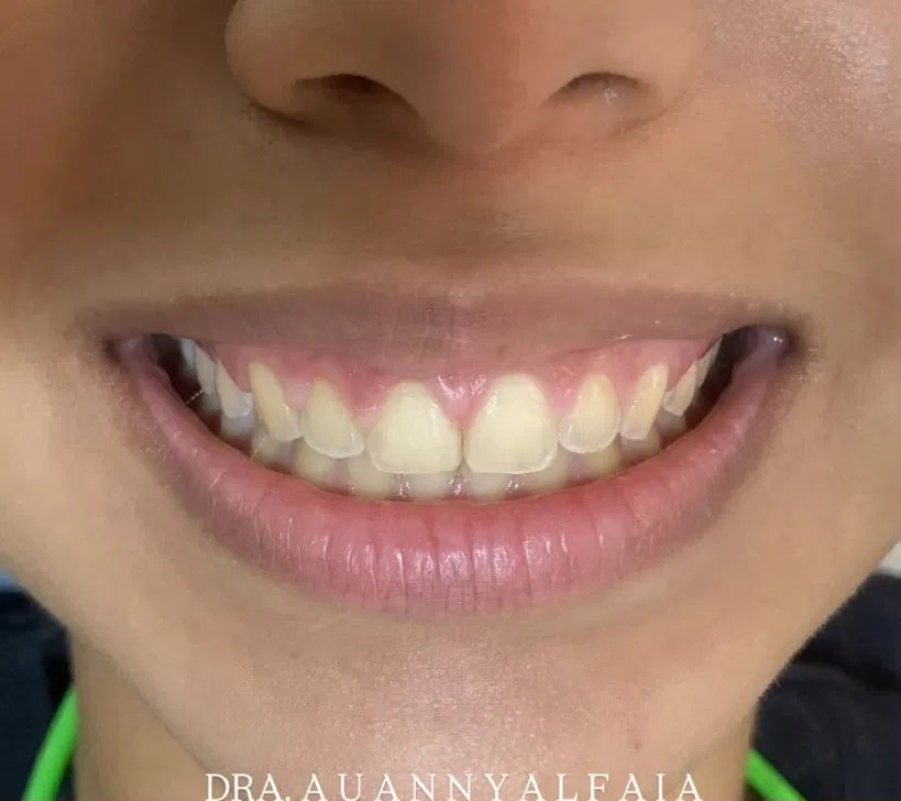 Resultado antes — Facetas em Resina