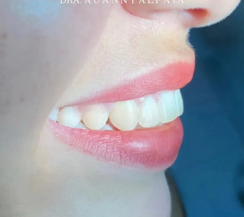 Resultado depois — ajuste de forma dental