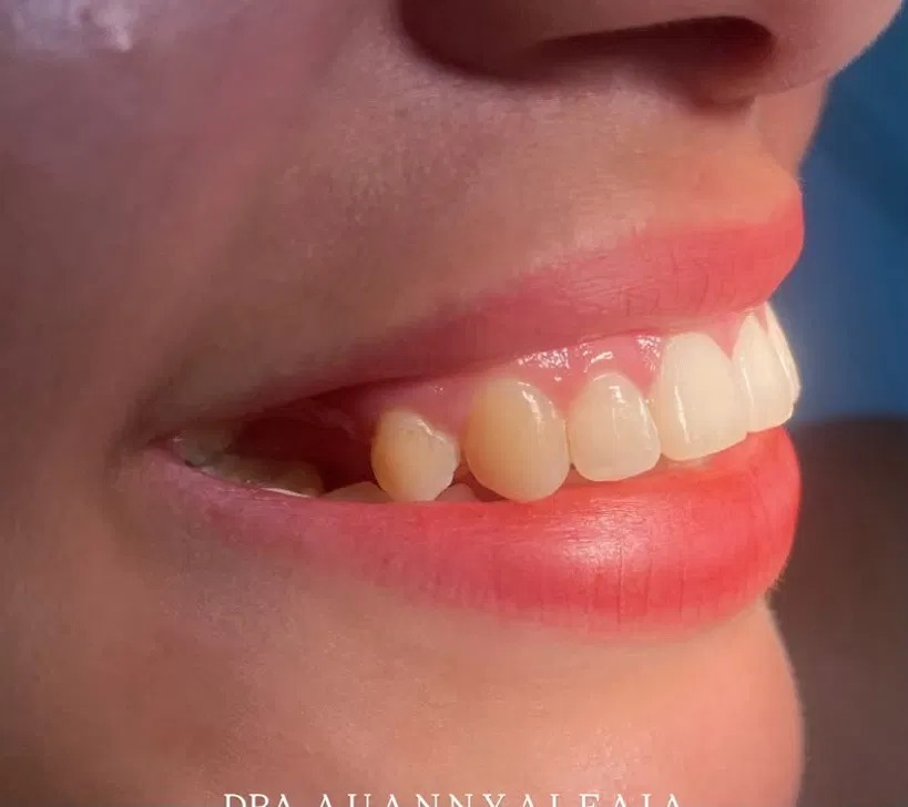 Resultado antes — ajuste de forma dental