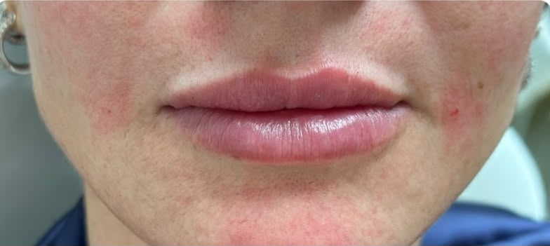 Resultado depois — Preenchimento Labial