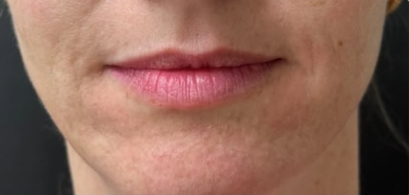 Resultado antes — Preenchimento Labial